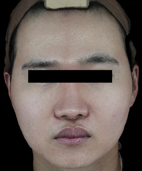 After — ปรับรูปหน้าด้วย ONDA