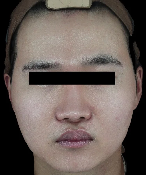 After — ONDA face contouring