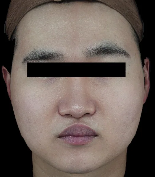 Before — ปรับรูปหน้าด้วย ONDA