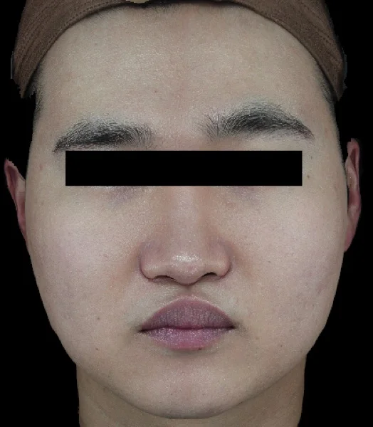Before — ONDA face contouring