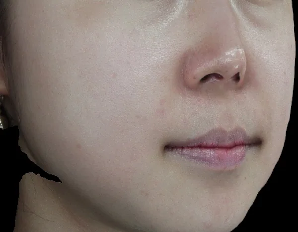 After — เลเซอร์รักษาเม็ดสี