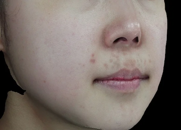 Pigmentation laser treatment — Before
