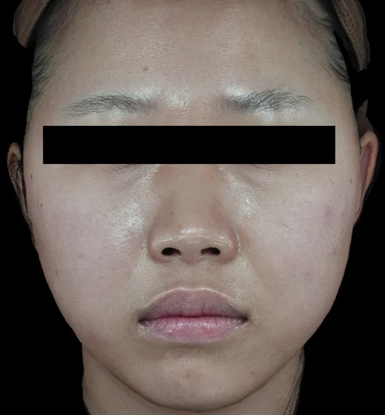 After — Potenza scar remodeling