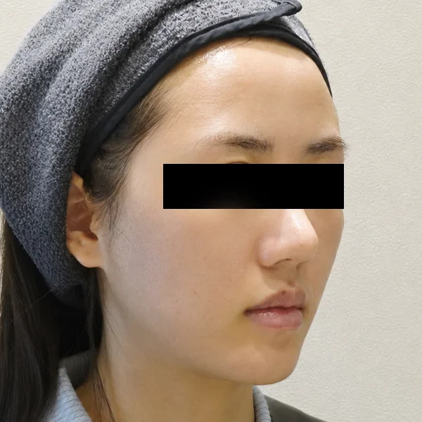 시술 후 — 포텐자 피부 리모델링 (스킨부스터 병행)