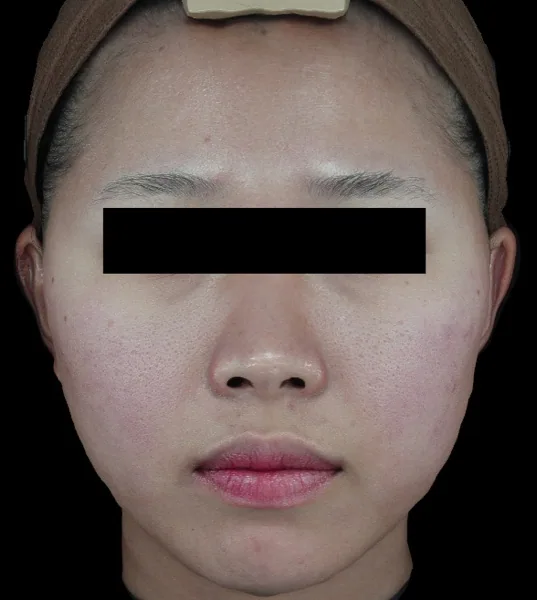 Before — ปรับแผลเป็นด้วย Potenza