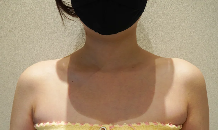 肩ラインのヒアルロン酸フィラー — 治療前