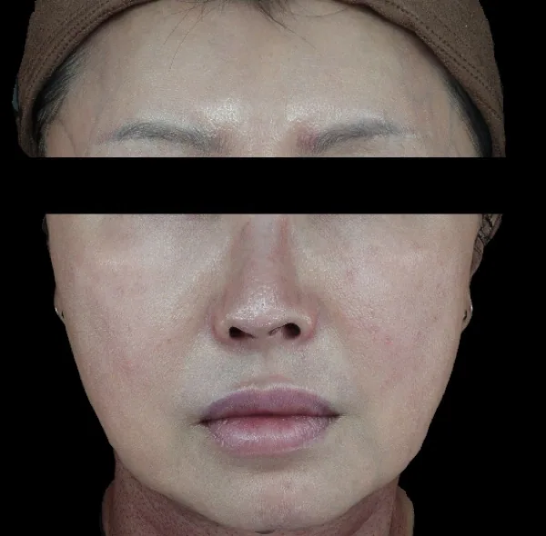 After — ฟื้นฟูผิวด้วย Skin Booster