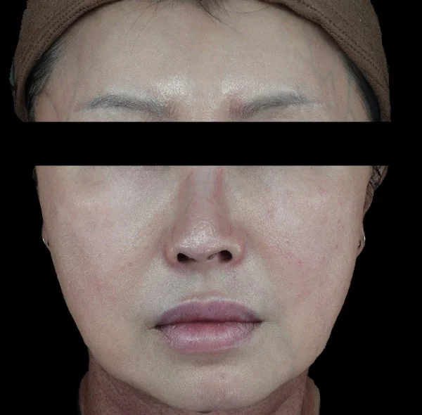 After — Skin booster rejuvenation