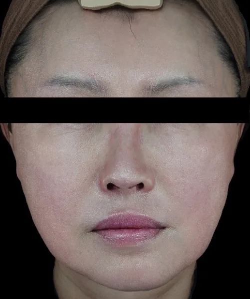 Before — ฟื้นฟูผิวด้วย Skin Booster