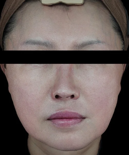 Before — Skin booster rejuvenation