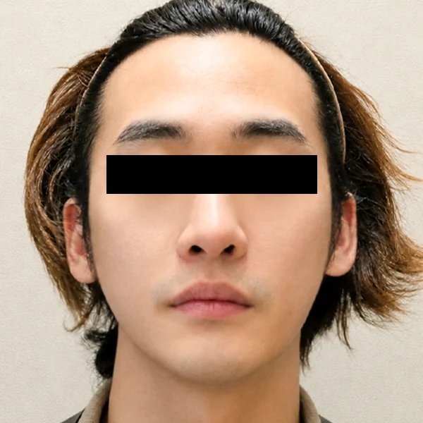 시술 후 — 복합 리프팅 프로그램 (소프웨이브·울쎄라·스컬트라)