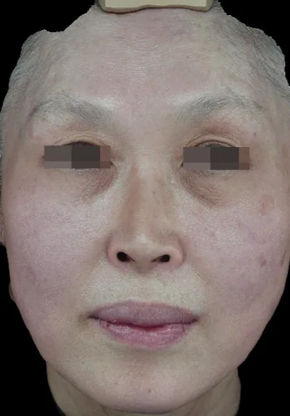 After — Thermage FLX ยกกระชับ