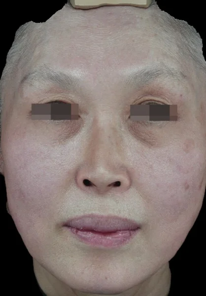 After — Thermage FLX tightening