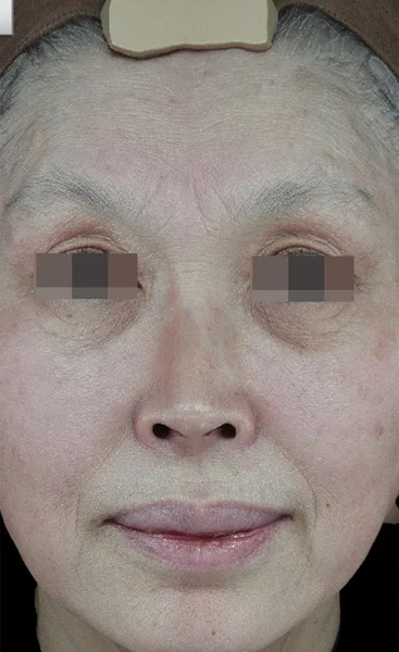 Before — Thermage FLX tightening