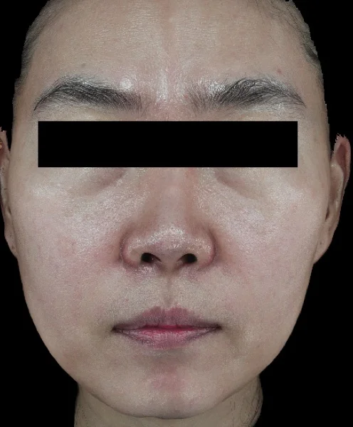 After — Ultherapy lifting treatment