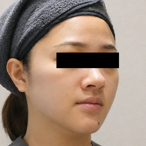 시술 후 — 울쎄라 리프팅 시술