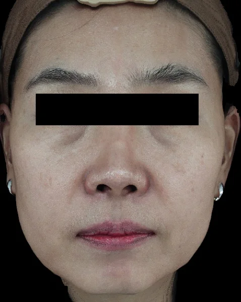 Before — Ultherapy lifting treatment