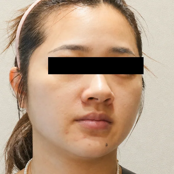 시술 전 — 울쎄라 리프팅 시술