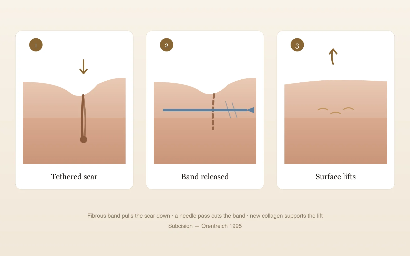 Three-panel diagram of subcision: a fibrous band tethering a rolling scar downward, a needle passed beneath the scar releasing the band, and the surface lifting as new collagen forms during healing