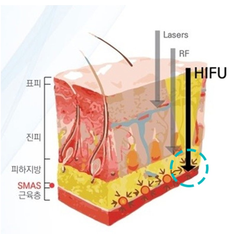 HIFU vs Ultherapy vs Thermage Seoul | Three-Way Decision Guide