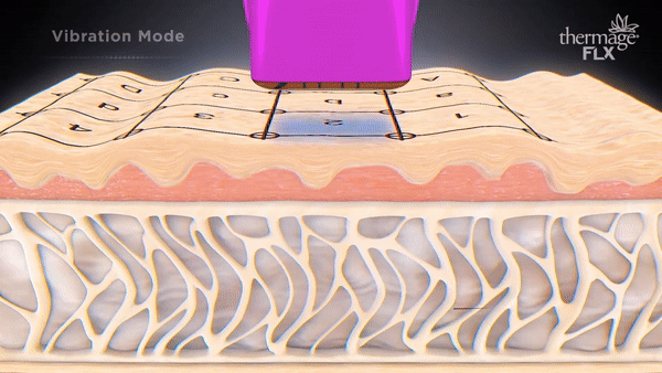 Thermage Monopolar RF ให้ความร้อนที่ชั้นหนังแท้พร้อมสารหล่อเย็นปกป้องผิวชั้นบน