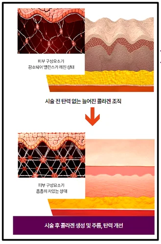 ผลของ Thermage FLX ในการเพิ่มความหนาผิวและลดริ้วรอย