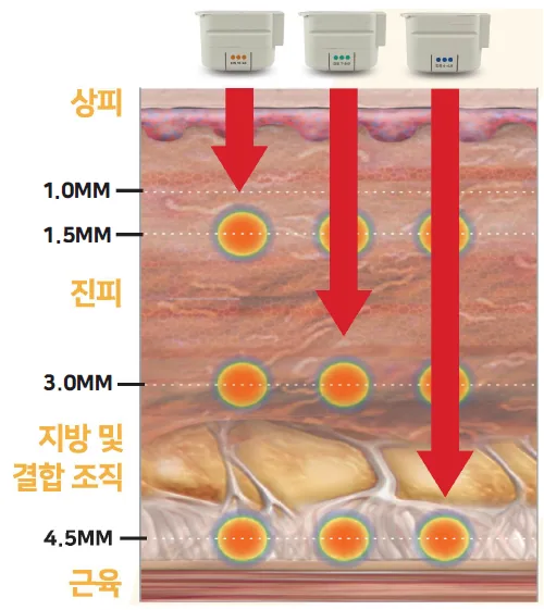 ความลึกของการทำ Ultherapy MFU-V ที่ 1.5 มม., 3.0 มม. (ชั้นหนังแท้) และ 4.5 มม. (SMAS)