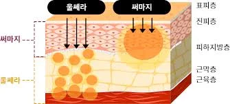 써마지 vs 울쎄라 서울 — 근거 기반 비교
